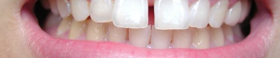 Gapped teeth