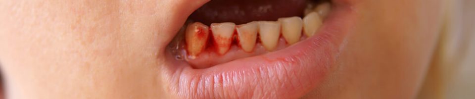 Bleeding gums caused by tooth picking Tooth picks cause bleeding gums