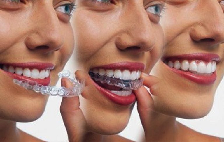 invisalign