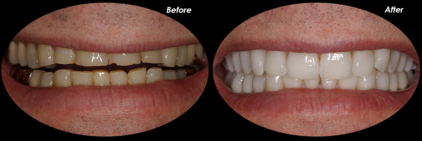 porcelain veneers