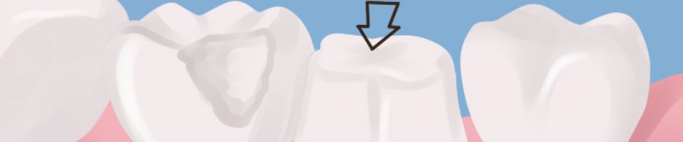 Dental Crowns