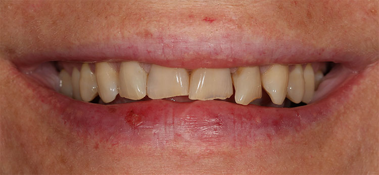 Veneers Before & After Photo