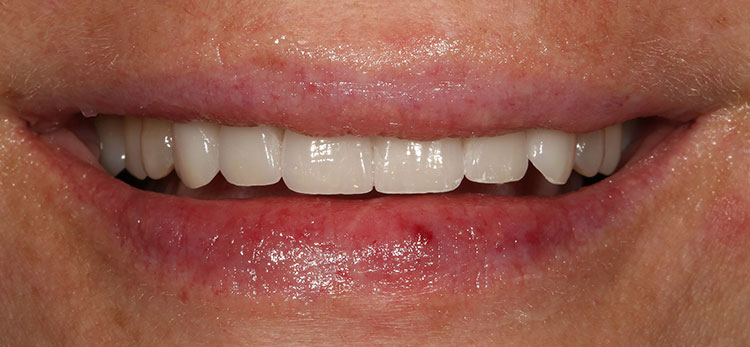 Veneers Before & After Photo