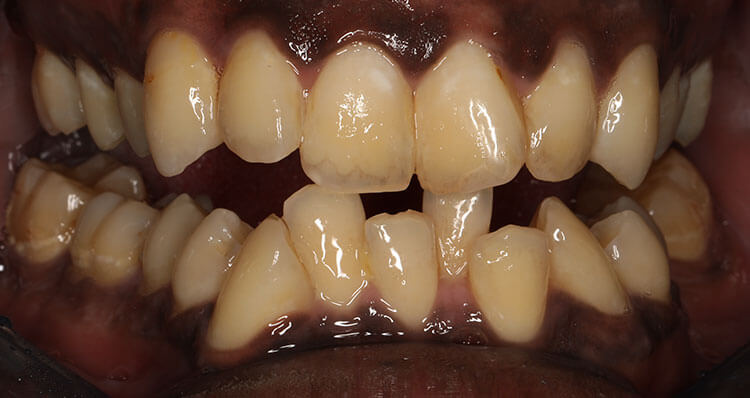 Full Mouth Reconstruction Before & After Photo