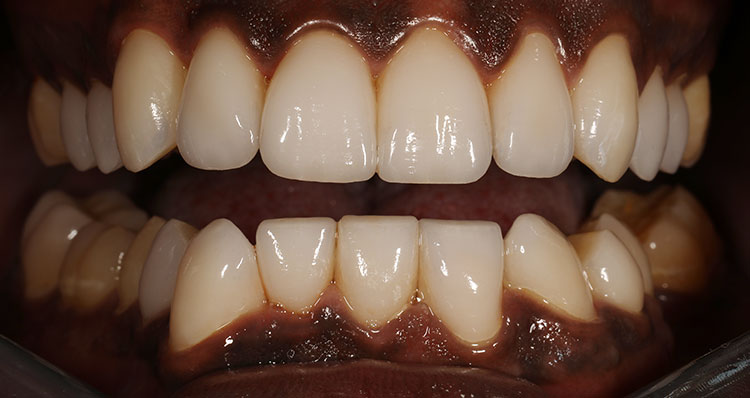 Full Mouth Reconstruction Before & After Photo