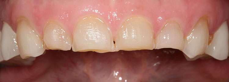 Veneers Before & After Photo