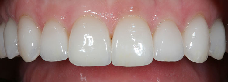 Veneers Before & After Photo