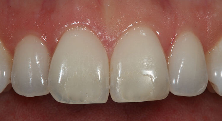 Veneers Before & After Photo