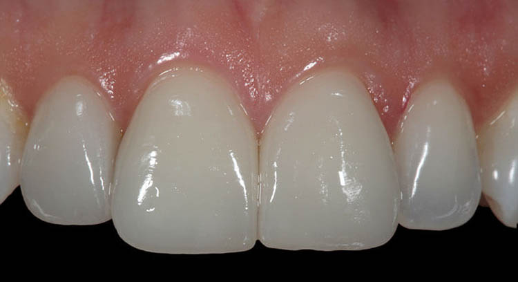 Veneers Before & After Photo