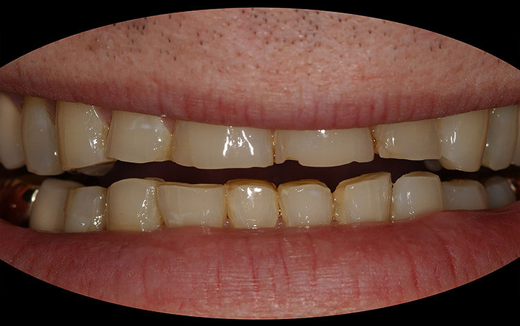 Veneers Before & After Photo