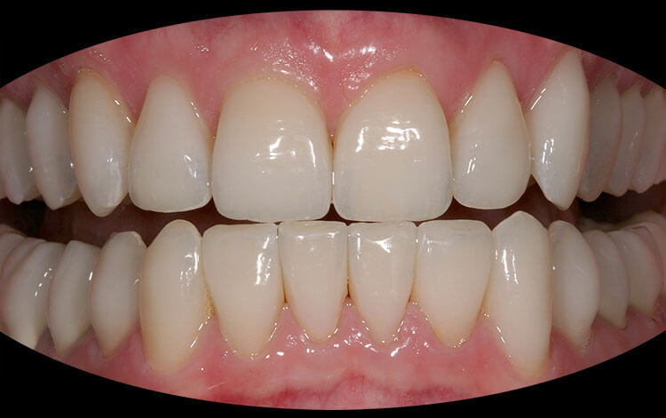 Veneers Before & After Photo