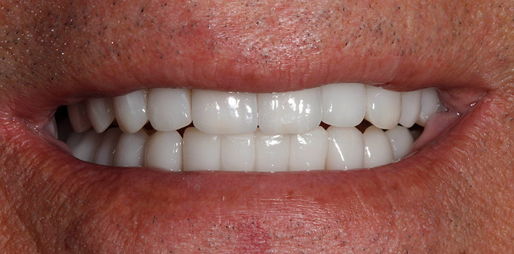 Full Mouth Restoration Before & After Photo