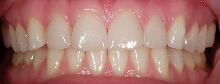 Veneers Before & After Photo