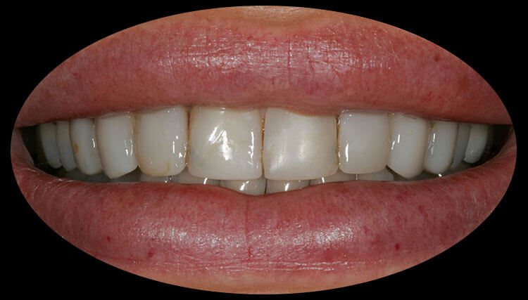 Veneers Before & After Photo