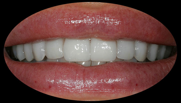 Veneers Before & After Photo