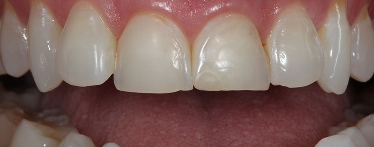 Veneers Before & After Photo