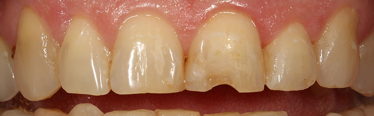 Veneers Before & After Photo