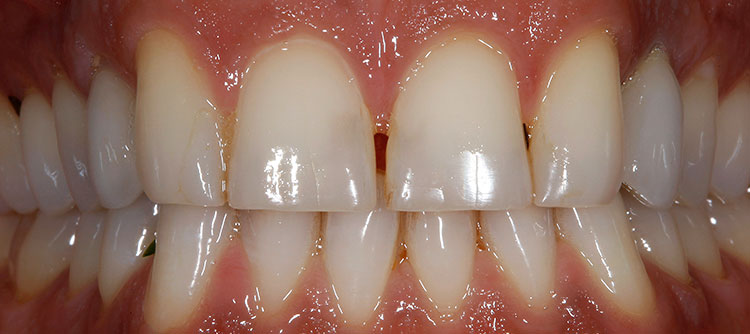 Veneers Before & After Photo