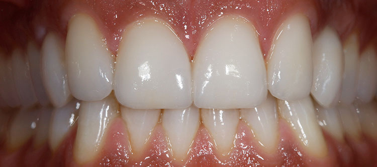 Veneers Before & After Photo