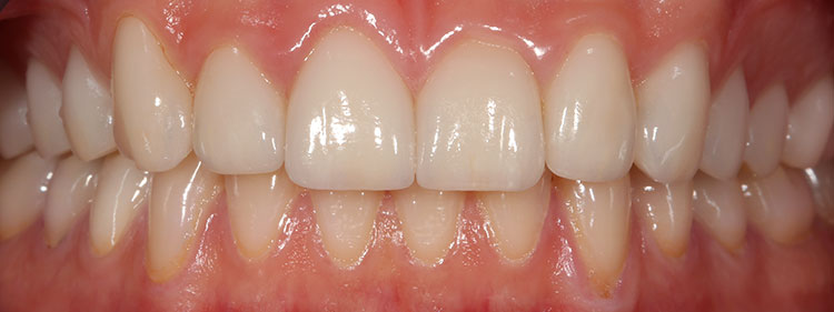 Veneers Before & After Photo