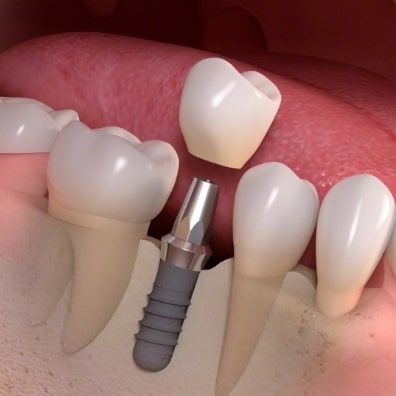 Single tooth implants