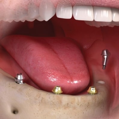 all on 4 dental implants