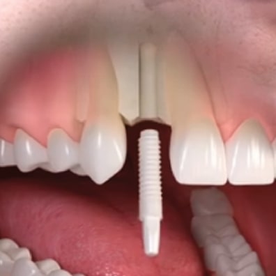 front tooth implants