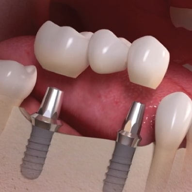 Multiple teeth implants