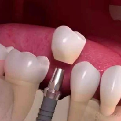 dental implants in one day